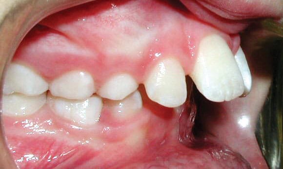 Protrusion Solitaire Orthodontics in Cypress, TX