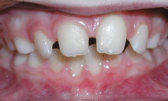 Spacing Solitaire Orthodontics in Cypress, TX