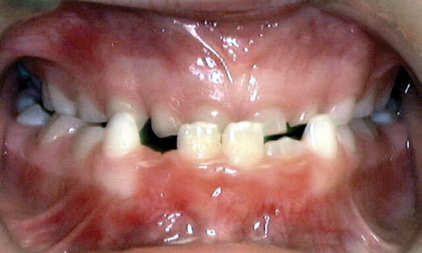 Underbite Solitaire Orthodontics in Cypress, TX