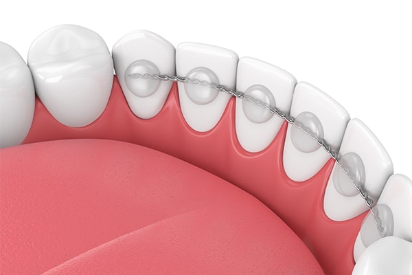 Fixed Retainers Solitaire Orthodontics in Cypress, TX