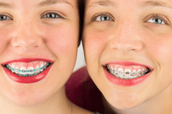 Types of Braces Solitaire Orthodontics in Cypress, TX